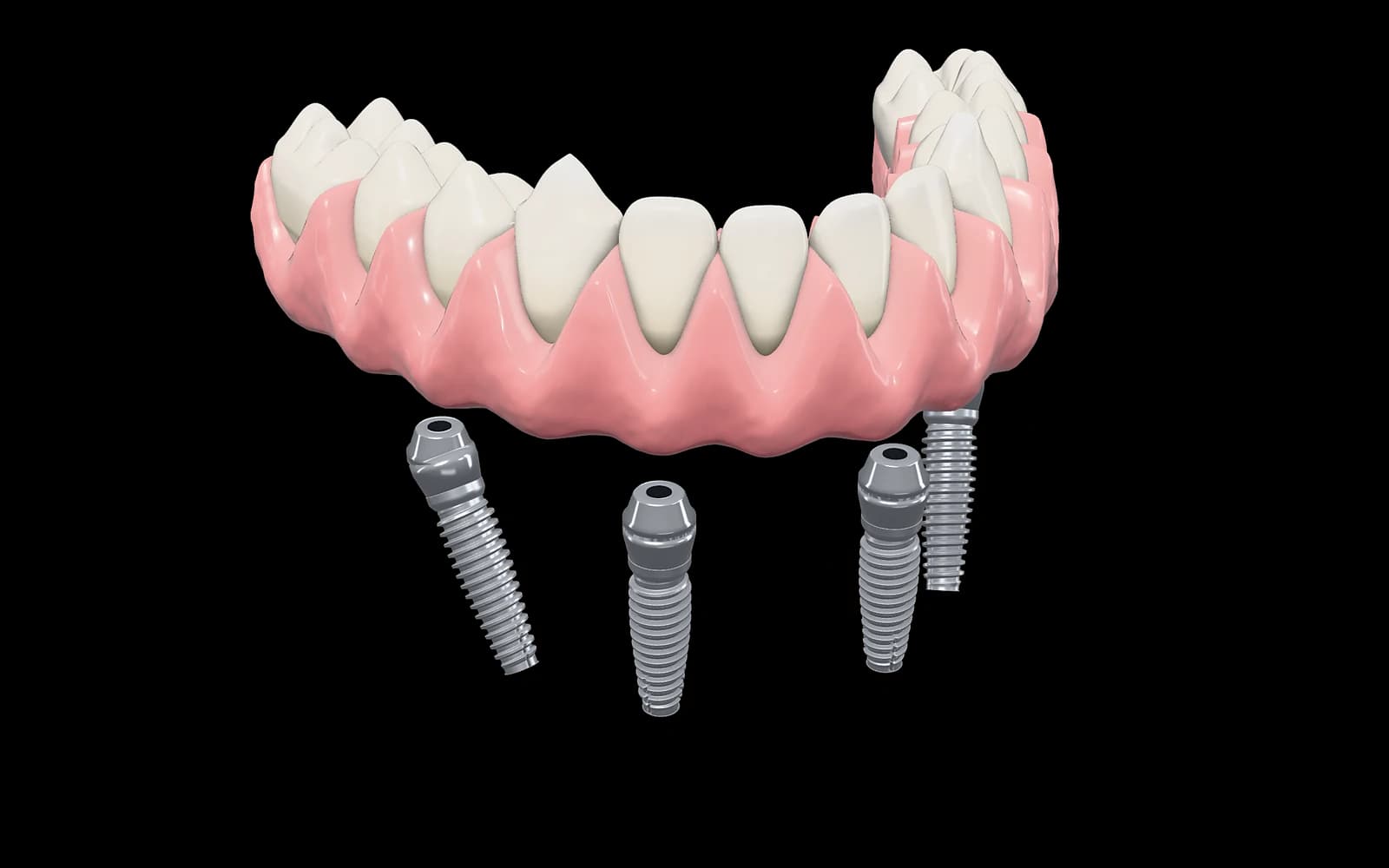 Ilustración 3D de una prótesis fija de arcada inferior separada ligeramente de cuatro implantes de titanio con sus pilares; los dos implantes posteriores están inclinados