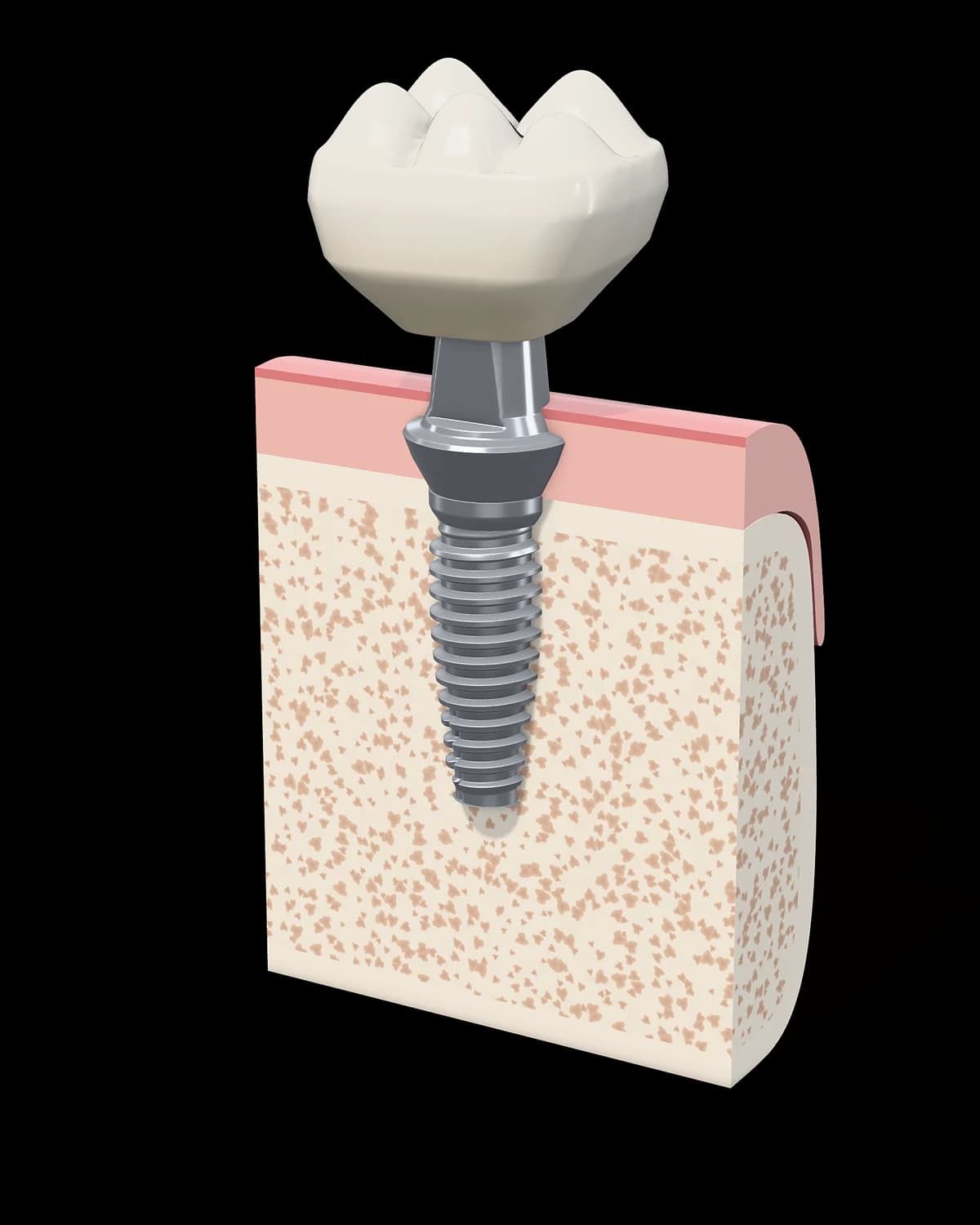 Ilustración 3D de un implante dental de titanio colocado en el hueso, con su pilar y una corona de molar sobre la encía, en corte transversal